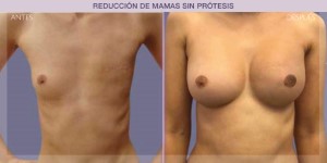 Before and after image of a post-cancer breast reconstruction procedure.